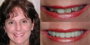 smile makeover example san diego cosmetic dentist best porcelain dental veneers before after 35