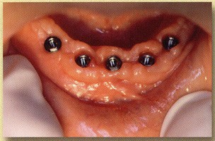 Dental-Implant-3