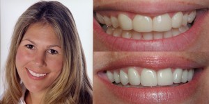 smile makeover mommy san diego cosmetic dentist best porcelain dental veneers before after 46