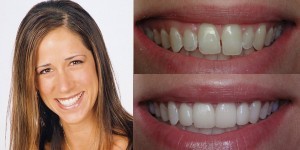 fixed gapped teeth san diego cosmetic dentist best porcelain dental veneers before after 43