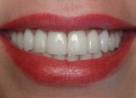 ideal smile picture for san diego cosmetic dentist best porcelain dental veneers before after 11