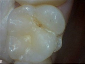 Tooth prior to laser treatment and sealant tx