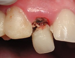 dental implant san diego cosmetic dentist best porcelain dental veneers before after 23
