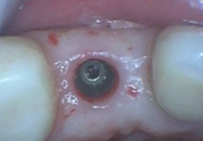 Tooth implant san diego cosmetic dentist best porcelain dental veneers before after 11