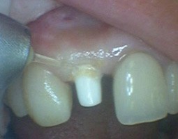 Dental implant san diego cosmetic dentist best porcelain dental veneers before after