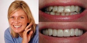 porcelain veneers san diego dental best cosmetic dentist before after wendy