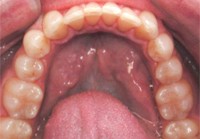 After San Diego Invisalign Treatment