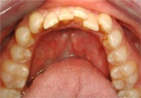 Before San Diego Invisalign Treatment upper arch