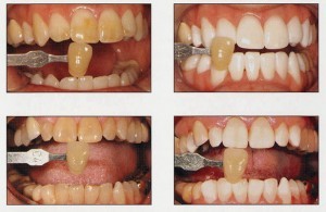 tooth whitening san diego cosmetic dentist best porcelain dental veneers before after