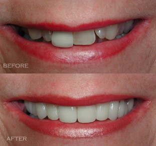instant orthodontics with porcelain veneers - before and after picture