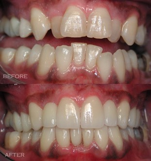 instant orthodontics with porcelain veneers - before and after