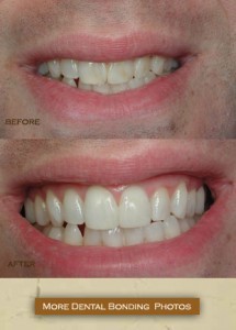 bonding san diego cosmetic dentist best porcelain dental veneers before after 11