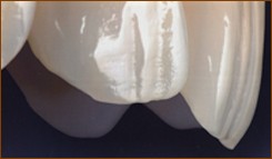 san diego cosmetic dentist best porcelain dental veneers before after 06