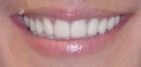 Temporary Veneers san diego cosmetic dentist best porcelain dental veneers before after 11