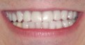 Temporary Veneers san diego cosmetic dentist best porcelain dental veneers before after