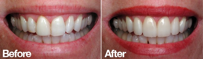 veneers straight teeth san diego cosmetic dentist best porcelain dental veneers before after 18