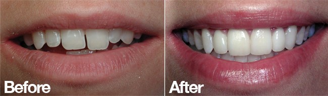 veneers closing spaces san diego cosmetic dentist best porcelain dental veneers before after 13