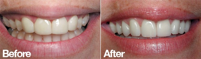 fixing veneers san diego 07 cosmetic dentist best porcelain dental veneers before after