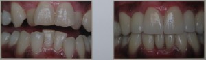 san diego cosmetic dentist best porcelain dental veneers before after 01