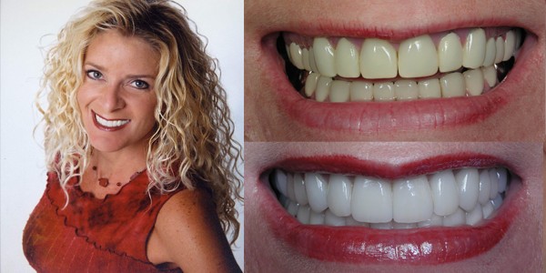 Kelley before and after san diego porcelain veneers