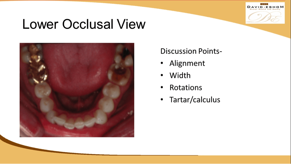 Lower Occlusal View