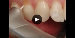 Waterlase MD Laser Dentistry