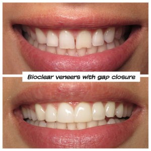 #bioclear #bioclearuveneers #bioclearsmilemakeover #smilemakeover #beforeandaftersmile #porcleainveneers #cosmeticdentist #cosmeticdentistry #sdcosmeticdentist #lajolladentist #invisalign #invisalignbeforeandafter #sdinvisalign #invisalignsd #sandiegodentist #sddentist #minimallyinvasivedentistry #notoothgrinding #cosmeticdentistsd #dentist #dentistry #dentaloffice #cosmeticdentaloffice #lajolla #bestofsandiego #beautifulsmile #straightteeth #perfectsmile #smile #sdspa