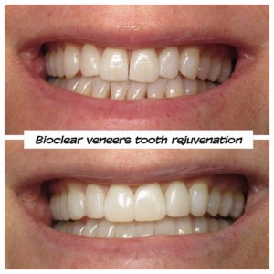 #bioclear #bioclearuveneers #bioclearsmilemakeover #smilemakeover #beforeandaftersmile #porcleainveneers #cosmeticdentist #cosmeticdentistry #sdcosmeticdentist #lajolladentist #invisalign #invisalignbeforeandafter #sdinvisalign #invisalignsd #sandiegodentist #sddentist #minimallyinvasivedentistry #notoothgrinding #cosmeticdentistsd #dentist #dentistry #dentaloffice #cosmeticdentaloffice #lajolla #bestofsandiego #beautifulsmile #straightteeth #perfectsmile #smile #sdspa