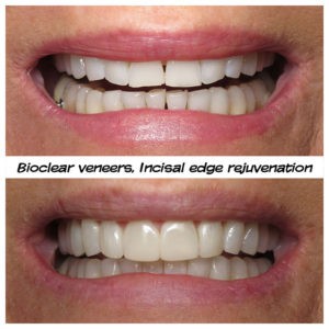 #bioclear #bioclearuveneers #bioclearsmilemakeover #smilemakeover #beforeandaftersmile #porcleainveneers #cosmeticdentist #cosmeticdentistry #sdcosmeticdentist #lajolladentist #invisalign #invisalignbeforeandafter #sdinvisalign #invisalignsd #sandiegodentist #sddentist #minimallyinvasivedentistry #notoothgrinding #cosmeticdentistsd #dentist #dentistry #dentaloffice #cosmeticdentaloffice #lajolla #bestofsandiego #beautifulsmile #straightteeth #perfectsmile #smile #sdspa