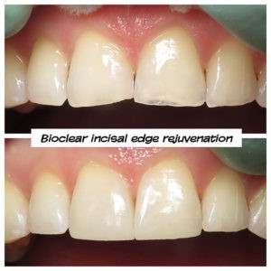 #bioclear #bioclearuveneers #bioclearsmilemakeover #smilemakeover #beforeandaftersmile #porcleainveneers #cosmeticdentist #cosmeticdentistry #sdcosmeticdentist #lajolladentist #invisalign #invisalignbeforeandafter #sdinvisalign #invisalignsd #sandiegodentist #sddentist #minimallyinvasivedentistry #notoothgrinding #cosmeticdentistsd #dentist #dentistry #dentaloffice #cosmeticdentaloffice #lajolla #bestofsandiego #beautifulsmile #straightteeth #perfectsmile #smile #sdspa