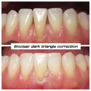 #bioclear #bioclearuveneers #bioclearsmilemakeover #smilemakeover #beforeandaftersmile #porcleainveneers #cosmeticdentist #cosmeticdentistry #sdcosmeticdentist #lajolladentist #invisalign #invisalignbeforeandafter #sdinvisalign #invisalignsd #sandiegodentist #sddentist #minimallyinvasivedentistry #notoothgrinding #cosmeticdentistsd #dentist #dentistry #dentaloffice #cosmeticdentaloffice #lajolla #bestofsandiego #beautifulsmile #straightteeth #perfectsmile #smile #sdspa