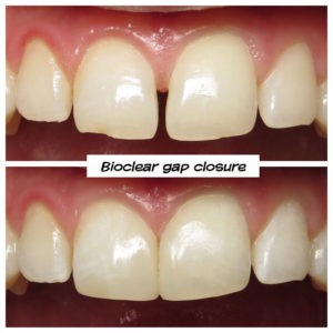 #bioclear #bioclearuveneers #bioclearsmilemakeover #smilemakeover #beforeandaftersmile #porcleainveneers #cosmeticdentist #cosmeticdentistry #sdcosmeticdentist #lajolladentist #invisalign #invisalignbeforeandafter #sdinvisalign #invisalignsd #sandiegodentist #sddentist #minimallyinvasivedentistry #notoothgrinding #cosmeticdentistsd #dentist #dentistry #dentaloffice #cosmeticdentaloffice #lajolla #bestofsandiego #beautifulsmile #straightteeth #perfectsmile #smile #sdspa