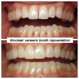 #bioclear #bioclearuveneers #bioclearsmilemakeover #smilemakeover #beforeandaftersmile #porcleainveneers #cosmeticdentist #cosmeticdentistry #sdcosmeticdentist #lajolladentist #invisalign #invisalignbeforeandafter #sdinvisalign #invisalignsd #sandiegodentist #sddentist #minimallyinvasivedentistry #notoothgrinding #cosmeticdentistsd #dentist #dentistry #dentaloffice #cosmeticdentaloffice #lajolla #bestofsandiego #beautifulsmile #straightteeth #perfectsmile #smile #sdspa
