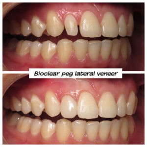 #bioclear #bioclearuveneers #bioclearsmilemakeover #smilemakeover #beforeandaftersmile #porcleainveneers #cosmeticdentist #cosmeticdentistry #sdcosmeticdentist #lajolladentist #invisalign #invisalignbeforeandafter #sdinvisalign #invisalignsd #sandiegodentist #sddentist #minimallyinvasivedentistry #notoothgrinding #cosmeticdentistsd #dentist #dentistry #dentaloffice #cosmeticdentaloffice #lajolla #bestofsandiego #beautifulsmile #straightteeth #perfectsmile #smile #sdspa