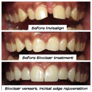 #bioclear #bioclearuveneers #bioclearsmilemakeover #smilemakeover #beforeandaftersmile #porcleainveneers #cosmeticdentist #cosmeticdentistry #sdcosmeticdentist #lajolladentist #invisalign #invisalignbeforeandafter #sdinvisalign #invisalignsd #sandiegodentist #sddentist #minimallyinvasivedentistry #notoothgrinding #cosmeticdentistsd #dentist #dentistry #dentaloffice #cosmeticdentaloffice #lajolla #bestofsandiego #beautifulsmile #straightteeth #perfectsmile #smile #sdspa