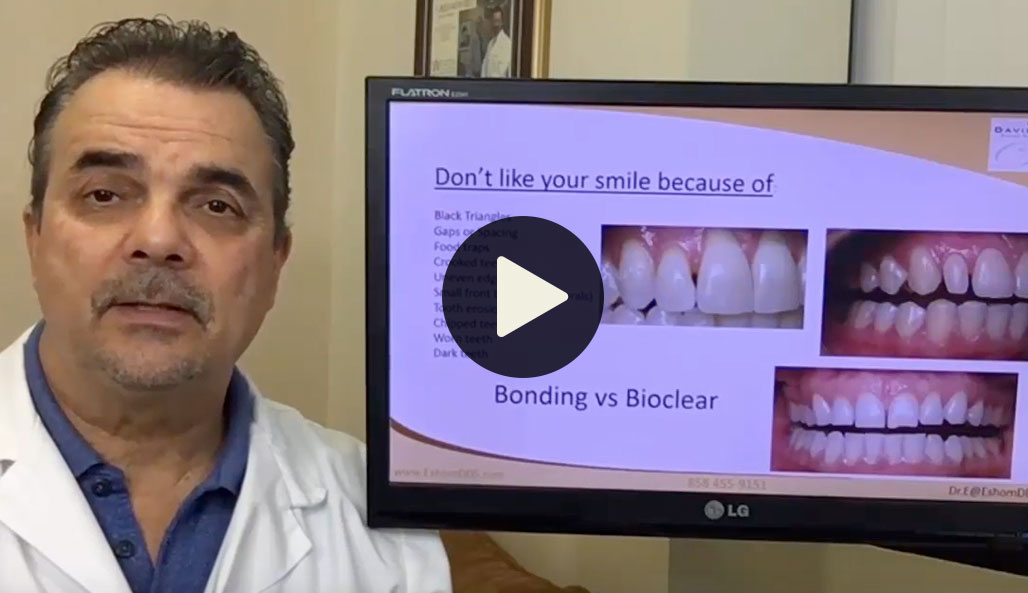 #bioclear #bioclearuveneers #bioclearsmilemakeover #smilemakeover #beforeandaftersmile #porcleainveneers #cosmeticdentist #cosmeticdentistry #sdcosmeticdentist #lajolladentist #invisalign #invisalignbeforeandafter #sdinvisalign #invisalignsd #sandiegodentist #sddentist #minimallyinvasivedentistry #notoothgrinding #cosmeticdentistsd #dentist #dentistry #dentaloffice #cosmeticdentaloffice #lajolla #bestofsandiego #beautifulsmile #straightteeth #perfectsmile #smile #sdspa