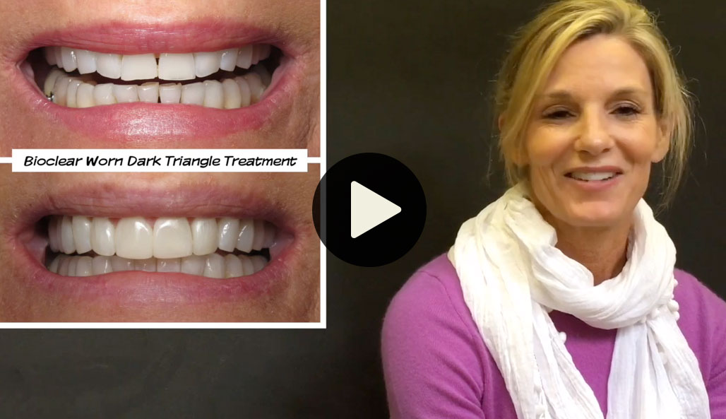 #bioclear #bioclearuveneers #bioclearsmilemakeover #smilemakeover #beforeandaftersmile #porcleainveneers #cosmeticdentist #cosmeticdentistry #sdcosmeticdentist #lajolladentist #invisalign #invisalignbeforeandafter #sdinvisalign #invisalignsd #sandiegodentist #sddentist #minimallyinvasivedentistry #notoothgrinding #cosmeticdentistsd #dentist #dentistry #dentaloffice #cosmeticdentaloffice #lajolla #bestofsandiego #beautifulsmile #straightteeth #perfectsmile #smile #sdspa
