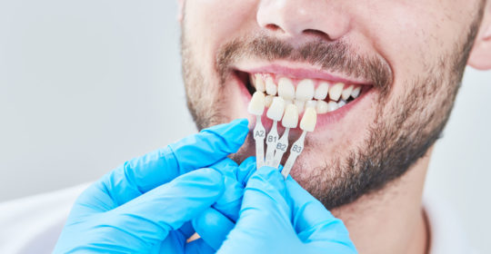 Veneers vs. Crowns: Which Is Right for You?