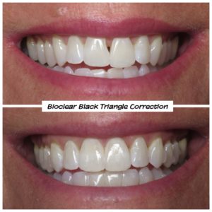 #bioclear #bioclearuveneers #bioclearsmilemakeover #smilemakeover #beforeandaftersmile #porcleainveneers #cosmeticdentist #cosmeticdentistry #sdcosmeticdentist #lajolladentist #invisalign #invisalignbeforeandafter #sdinvisalign #invisalignsd #sandiegodentist #sddentist #minimallyinvasivedentistry #notoothgrinding #cosmeticdentistsd #dentist #dentistry #dentaloffice #cosmeticdentaloffice #lajolla #bestofsandiego #beautifulsmile #straightteeth #perfectsmile #smile #sdspa