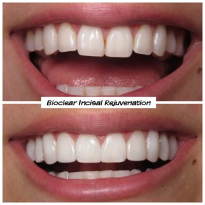 #bioclear #bioclearuveneers #bioclearsmilemakeover #smilemakeover #beforeandaftersmile #porcleainveneers #cosmeticdentist #cosmeticdentistry #sdcosmeticdentist #lajolladentist #invisalign #invisalignbeforeandafter #sdinvisalign #invisalignsd #sandiegodentist #sddentist #minimallyinvasivedentistry #notoothgrinding #cosmeticdentistsd #dentist #dentistry #dentaloffice #cosmeticdentaloffice #lajolla #bestofsandiego #beautifulsmile #straightteeth #perfectsmile #smile #sdspa
