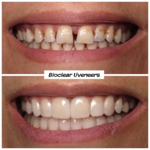 #bioclear #bioclearuveneers #bioclearsmilemakeover #smilemakeover #beforeandaftersmile #porcleainveneers #cosmeticdentist #cosmeticdentistry #sdcosmeticdentist #lajolladentist #invisalign #invisalignbeforeandafter #sdinvisalign #invisalignsd #sandiegodentist #sddentist #minimallyinvasivedentistry #notoothgrinding #cosmeticdentistsd #dentist #dentistry #dentaloffice #cosmeticdentaloffice #lajolla #bestofsandiego #beautifulsmile #straightteeth #perfectsmile #smile #sdspa Before and After: Bioclear Uveneers