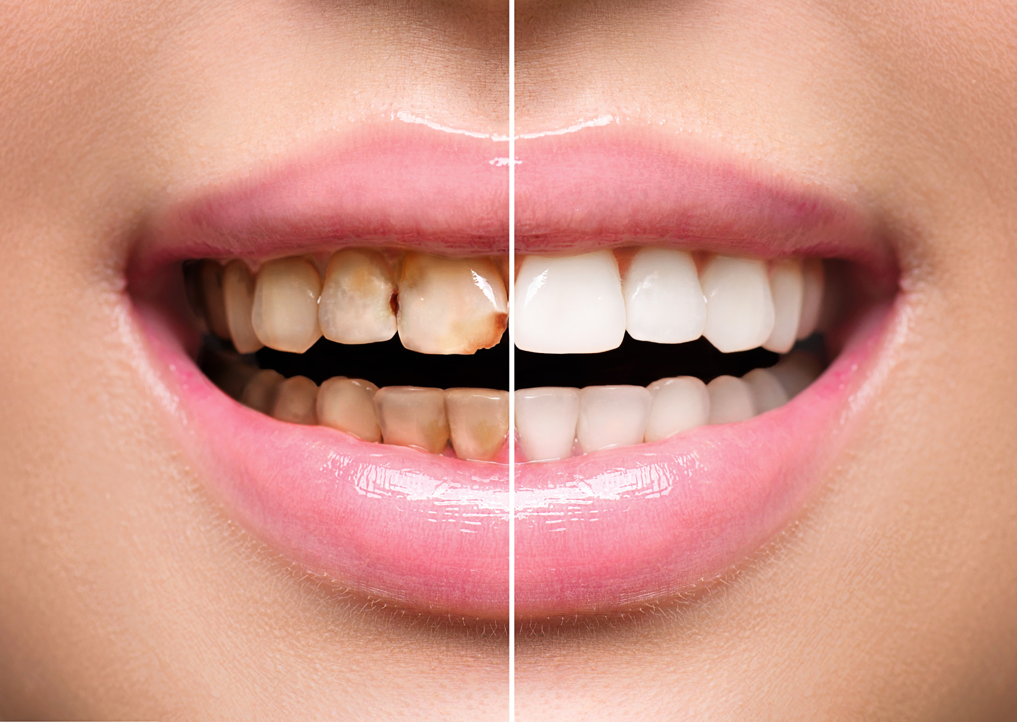 How Long Do Dental Veneers Typically Last?